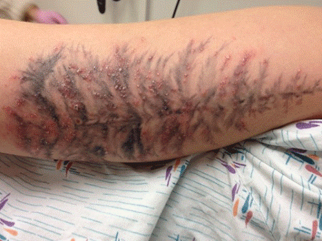 Xăm gây nhiễm khuẩn