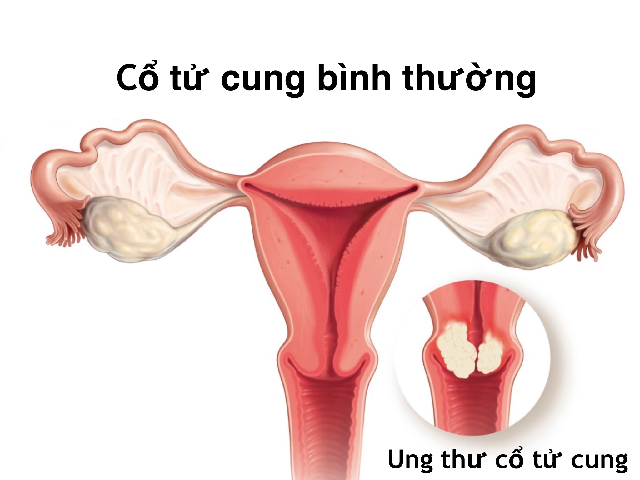 Ung thư cổ tử cung