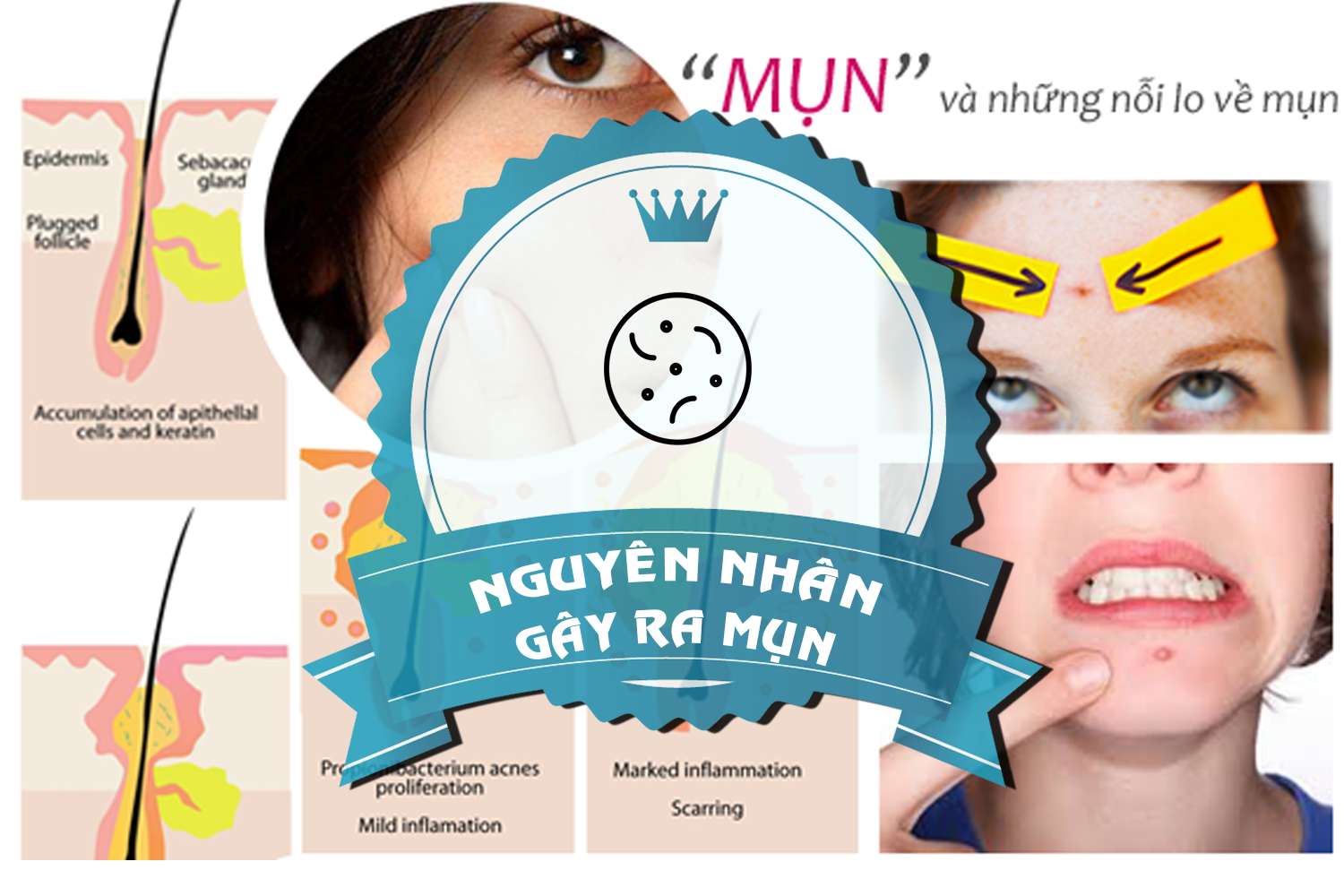 Nguyên nhân tại sao lại bị mụn? Nguyên nhân tại sao lại bị mụn?