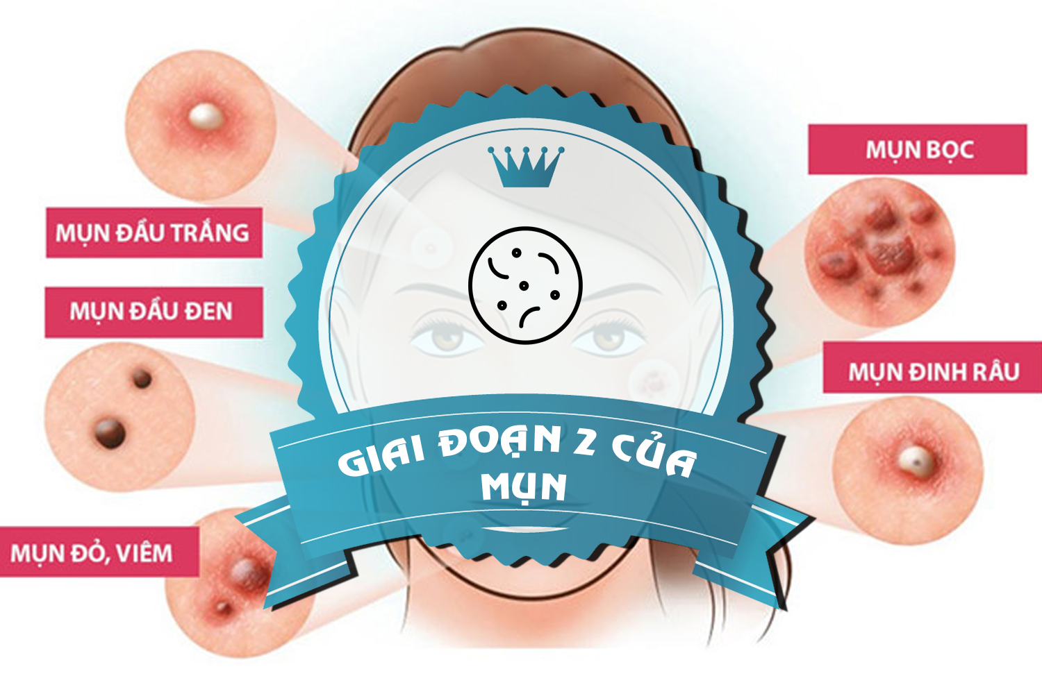 Tổng quan về các loại mụn Tổng quan về các loại mụn