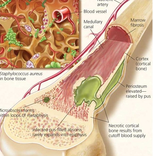 Bệnh viêm tủy xương ở gà