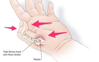 Chữa bệnh ngón tay cò súng bằng Diện Chẩn