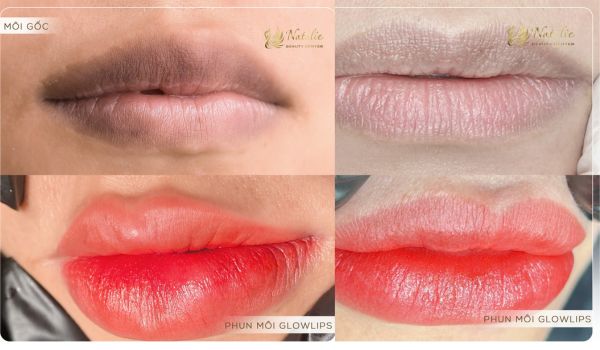 ảnh khử thâm một