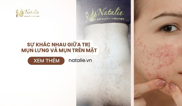 sự khác nhau trị mụn lưng và mặt