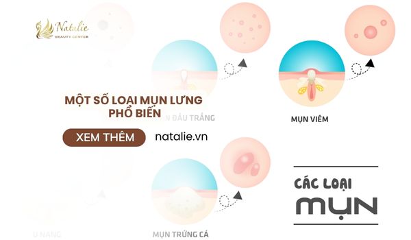 một số loại mụn lưng