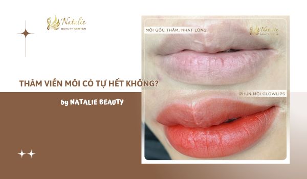 thâm viền môi tự hết không