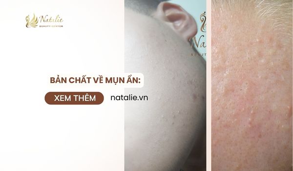 bản chất về mụn ẩn