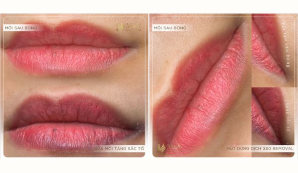 sửa môi hỏng sau phun