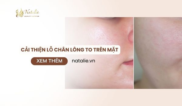 cải thiện lỗ chân lông
