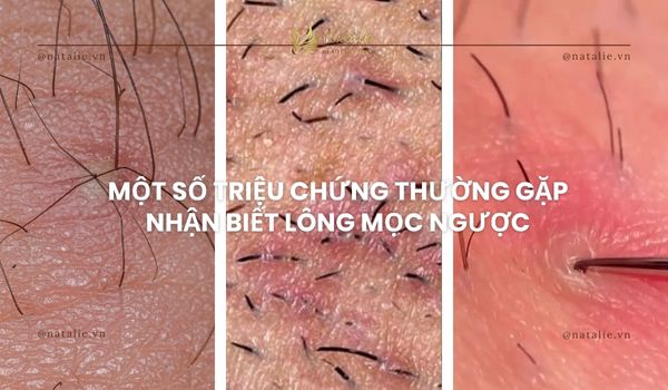 triệu chứng lông mọc ngược