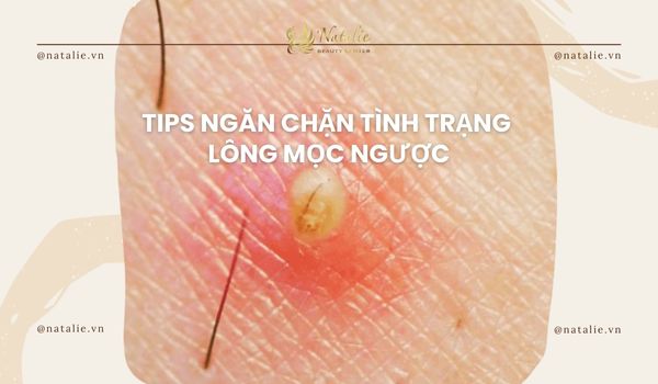 ngăn chặn lông mọc ngược