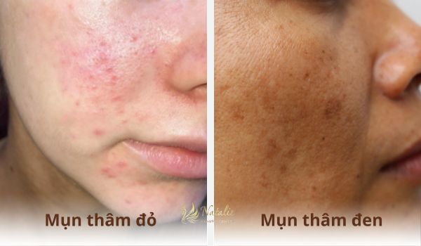 mụn thâm đỏ nâu