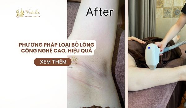 loại bỏ lông công nghệ cao
