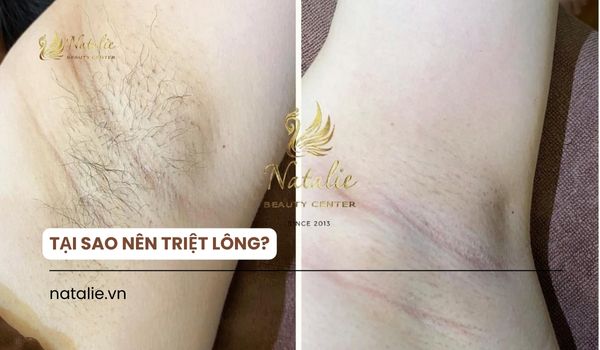 tại sao nên triệt lông