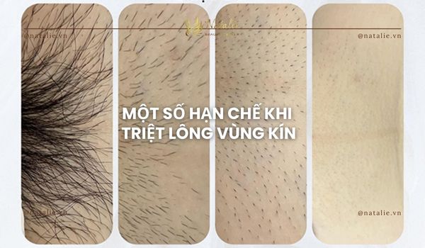 hạn chế triệt lông vùng kín