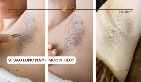 vì sao lông nách mọc nhiều