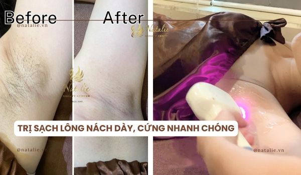 triệt sạch lông nách diode