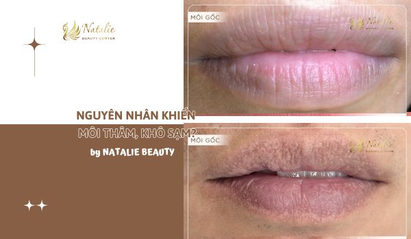 nguyên nhân môi thâm, khô