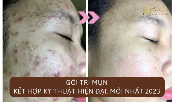 gói trị mụn kết hợp công nghệ hiện đại
