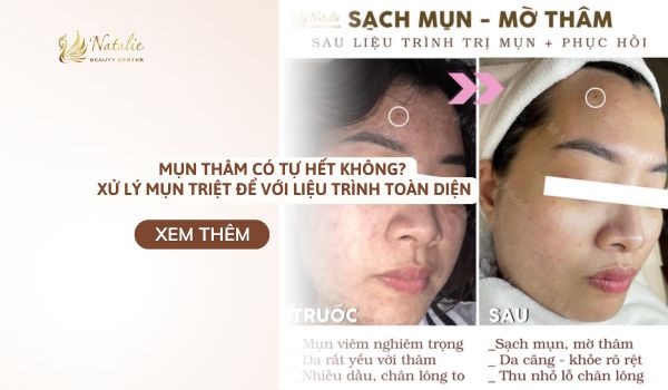 trị mụn toàn diện