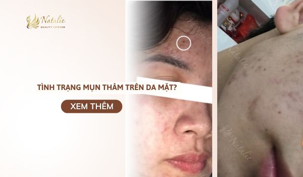 tình trạng mụn thâm trên mặt