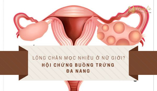 hội chứng buồng chứng đa năng