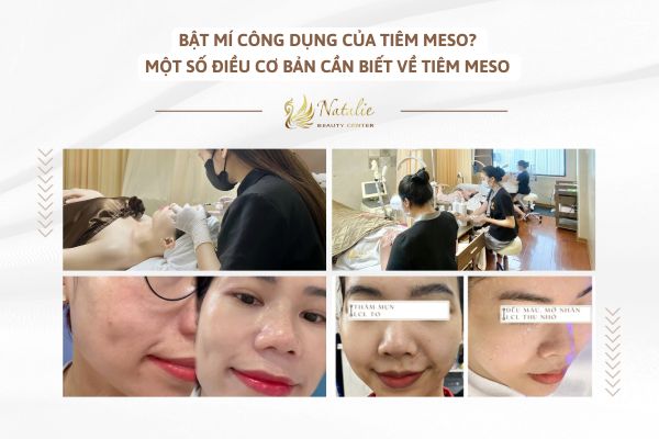 bật mí công dụng của tiêm meso