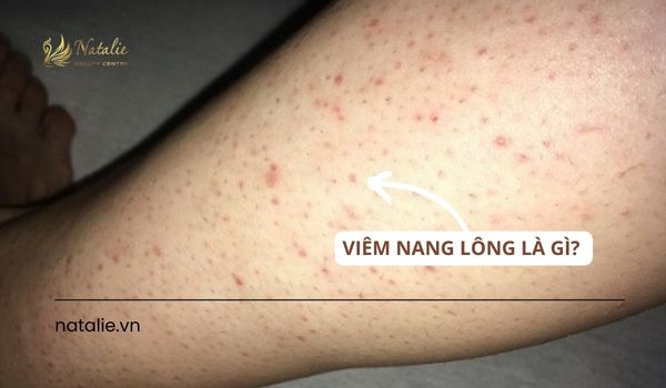 viêm nang lông là gì