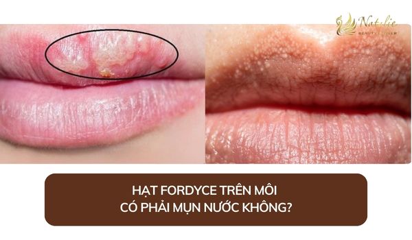 hạt fordyce và mụn nước khác nhau