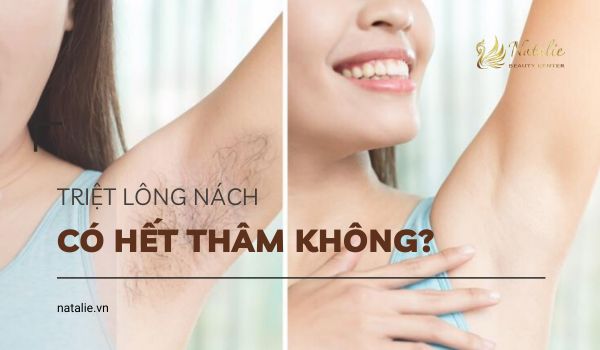  triệt lông nách có hết thâm không