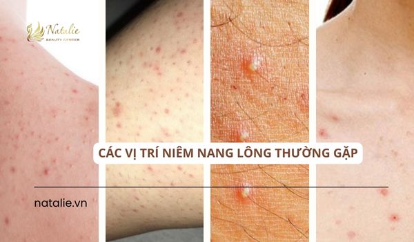 vị trí nang lông thường gặp