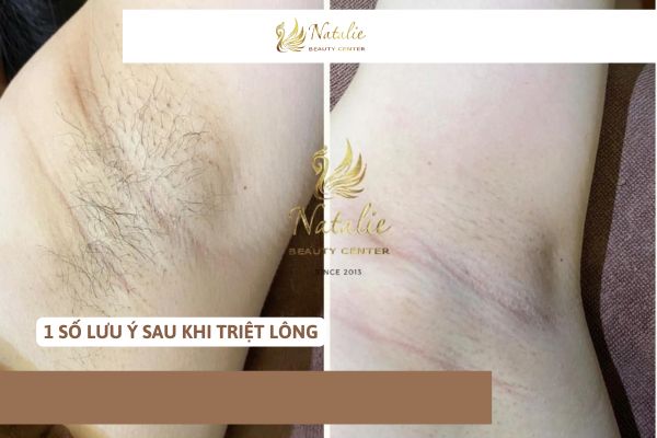 1 số lưu ý sau triệt lông