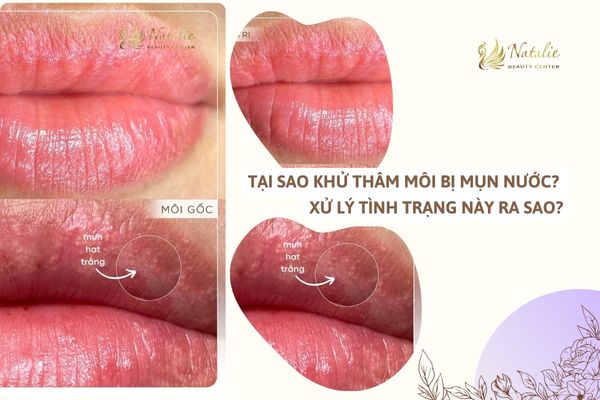 khử thâm môi bị mụn nước
