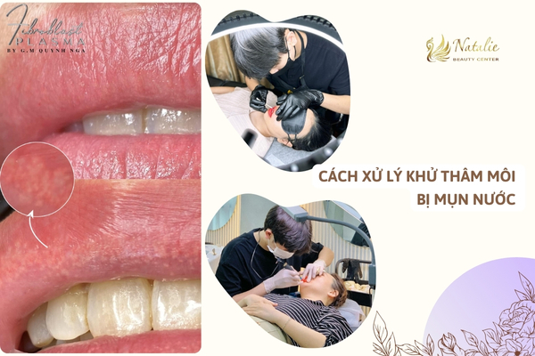 xử lý môi mụn nước
