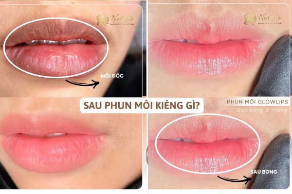 Sau phun kiêng gì na