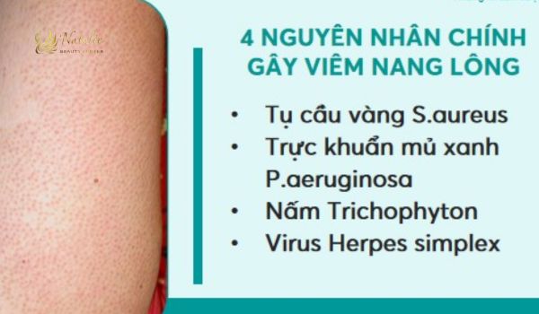 nguyên nhân chính gây viêm nang lông