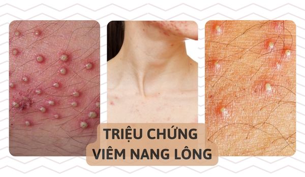 triệu chứng viêm nang lông