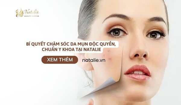 chăm sóc da mụn