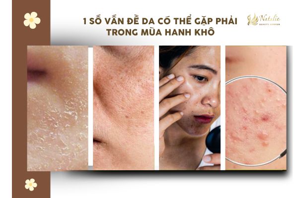 vấn đề da mùa khô