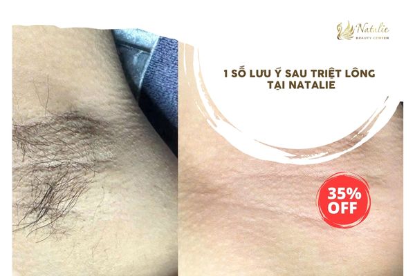 lưu ý sau triệt na