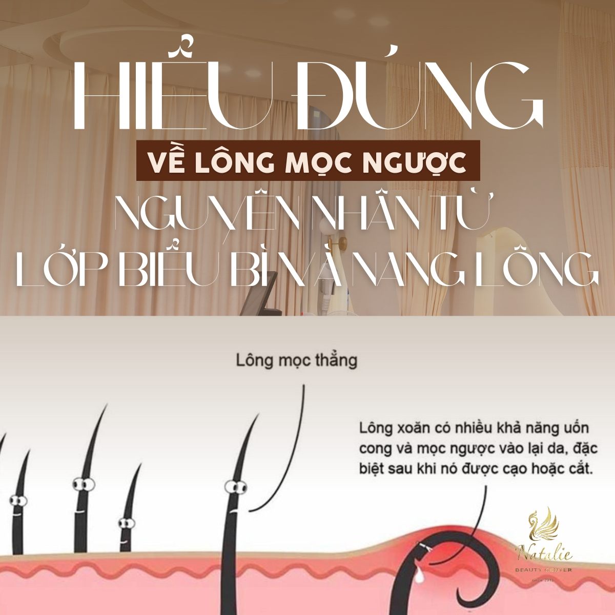 hiểu đúng lông mọc ngược