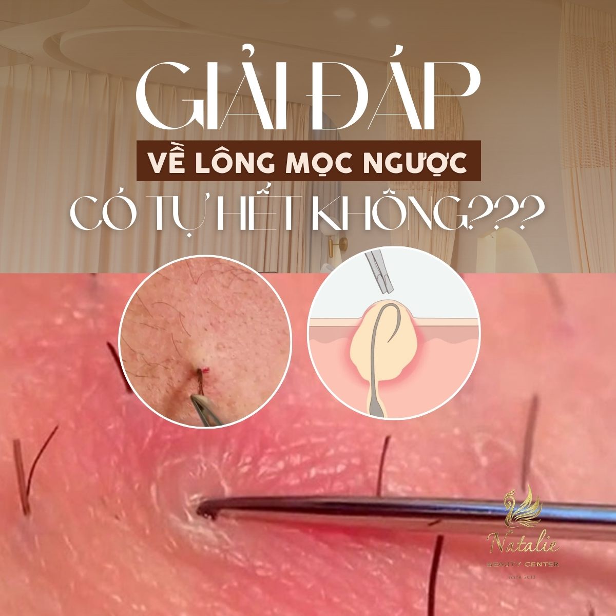 lông mọc ngược không tự hết