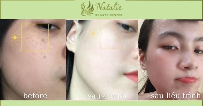 dieu-tri-nam-da-tan-nhang-bang-laser