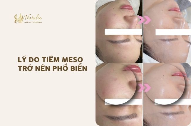 lý do meso phổ biến