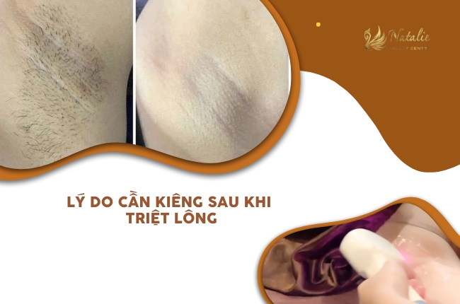 kiêng sau triệt