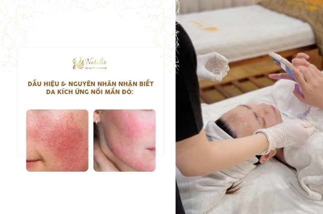 dấu hiệu nguyên nhân kích ứng