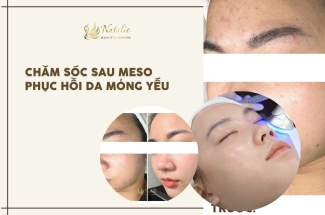 chăm sóc sau meso phục hồi