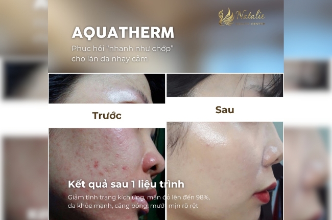 kết quả sau liệu trình aqua
