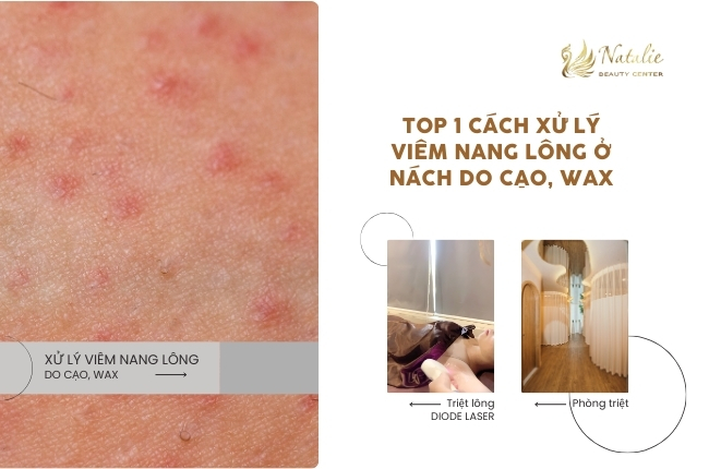 cách xử lý viêm nang lông nách