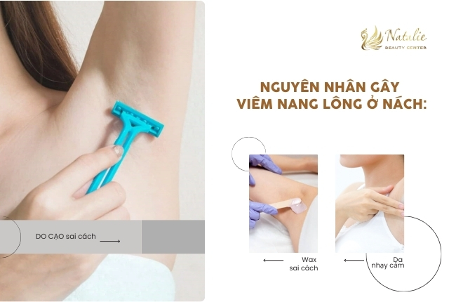 nguyên nhân viêm nang lông